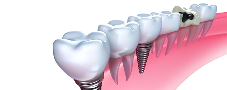 Dental Implants at St. Andrews Dental