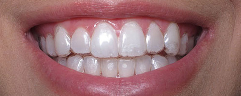 Invisalign at St. Andrews Dental